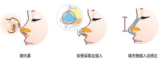 朝天鼻如何矯正 朝天鼻矯正術(shù)前術(shù)后注意事項