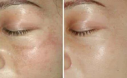 去除黃褐斑的價(jià)格一般是多少