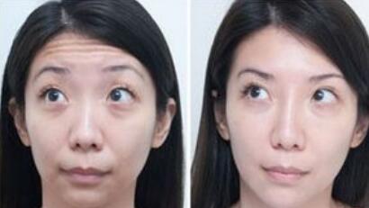 用什么方法能去皺、除皺多少錢