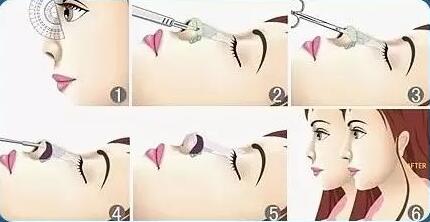 硅膠隆鼻費用是多少？貴嗎？