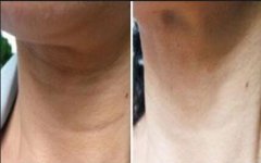 頸紋怎么消除*？那種方法好？