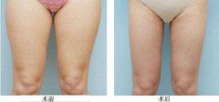 大腿抽脂多久恢復(fù)正常不痛，多久見(jiàn)？