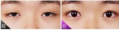 上瞼提肌手術(shù)有必要嗎？不做有什么危害？