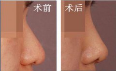 自體軟骨隆鼻是*的嗎？有哪些優(yōu)勢(shì)？