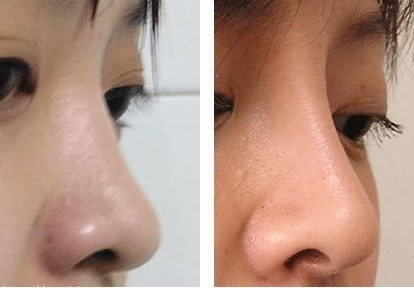 隆鼻后多久山根會(huì)自然？果能保持多久？