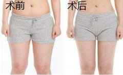 大腿吸脂有幾個(gè)切口？大腿環(huán)吸幾個(gè)切口？