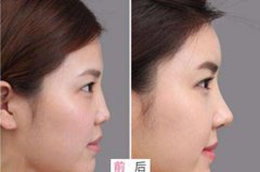 隆鼻手術(shù)3天拆了會歪嗎？歪了怎么辦？