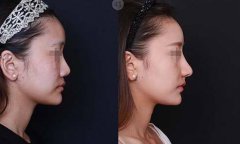 膨體隆鼻是*的嗎？多久恢復(fù)？