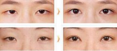 開(kāi)眼角需要多少錢(qián)？能讓眼睛變大嗎？