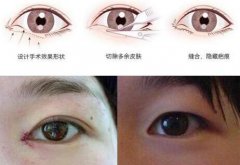 開眼角手術(shù)一定會增生嗎