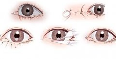 開(kāi)眼角失敗怎么辦？有疤怎么辦？