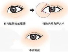 韓式*開(kāi)眼角價(jià)格