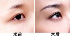種植眉毛的適合人群有哪些？眉毛種植果圖？