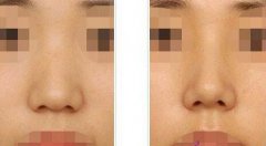 做了隆鼻手術(shù)后的護(hù)理，具體注意事項(xiàng)