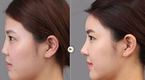 做了隆鼻手術(shù)后的護(hù)理，具體注意事項(xiàng)