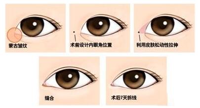 開(kāi)眼角手術(shù)風(fēng)險(xiǎn)大嗎