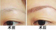 種植眉毛是怎么回事？種植眉毛有什么作用？