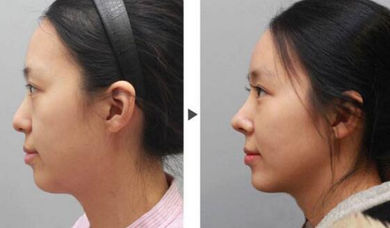 隆鼻術(shù)前注意，術(shù)前準(zhǔn)備有哪些