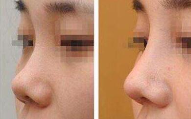 隆鼻術(shù)前注意，術(shù)前準(zhǔn)備有哪些