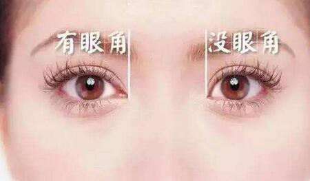 開眼角恢復時間要多久？多久恢復自然？