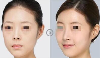 隆鼻固定膠帶幾天去掉?多久可以撕?