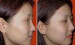 隆鼻以后怎么恢復(fù)快，術(shù)后如何護(hù)理?