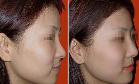 隆鼻以后怎么恢復(fù)快，術(shù)后如何護(hù)理?