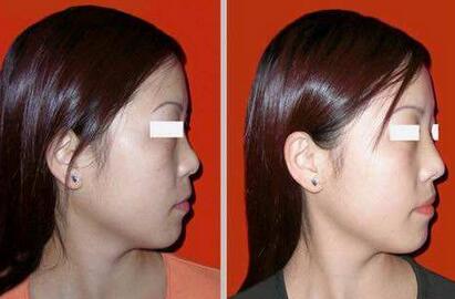 隆鼻以后怎么恢復(fù)快，術(shù)后如何護(hù)理?