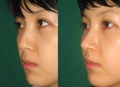 隆鼻手術(shù)恢復(fù)要多久，幾天恢復(fù)自然?