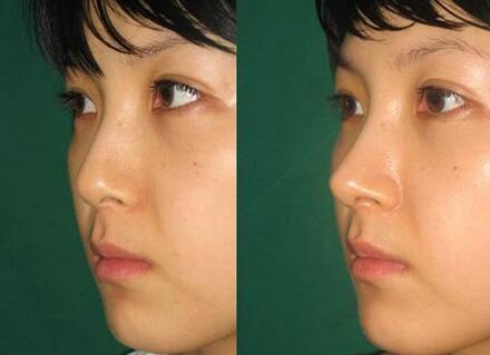 隆鼻手術(shù)恢復(fù)要多久，幾天恢復(fù)自然?