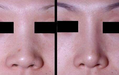 隆鼻手術(shù)恢復(fù)要多久，幾天恢復(fù)自然?