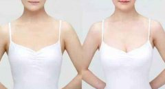 假體豐胸術(shù)后恢復(fù)注意事項(xiàng)？假體豐胸后需要注意哪些？