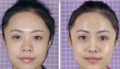 北京膨體隆鼻價格是多少？膨體隆鼻手術多少錢？