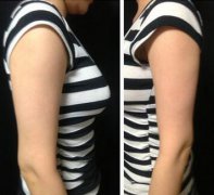 手臂吸脂術(shù)前準(zhǔn)備，術(shù)前注意事項(xiàng)有那些？