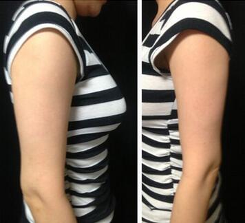 手臂吸脂術前準備，術前注意事項有那些？