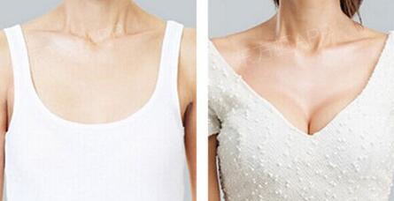 假體豐胸多久就不痛了，假體豐胸多久能恢復(fù)？