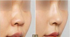 九院隆鼻多少錢？九院隆鼻醫(yī)生？