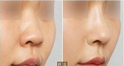 九院,隆鼻,多少錢,醫(yī)生