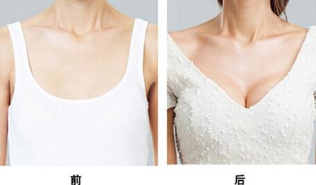 假體豐胸能保持多久，假體豐胸*果可以維持多久？