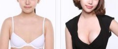 假體豐胸費(fèi)用多少錢(qián)？假體豐胸價(jià)格是多少？