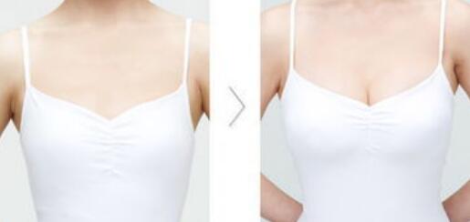 假體豐胸危害有哪些？假體豐胸有副作用嗎？