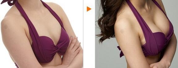 威寧假體豐胸怎么樣？威寧假體豐胸*果如何？