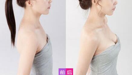 威寧假體豐胸怎么樣？威寧假體豐胸*果如何？