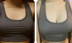 假體豐胸信息介紹？如何選醫(yī)院？