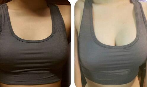 假體豐胸信息介紹？如何選醫(yī)院？