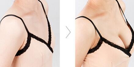 上海內(nèi)窺鏡假體豐胸怎么樣？*內(nèi)窺鏡假體豐胸介紹