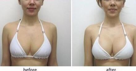 假體豐胸材料哪些好？假體豐胸*果圖