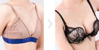 假體豐胸材料哪些好？假體豐胸*果圖