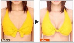 假體豐胸好的醫(yī)院有哪些？假體豐胸介紹？