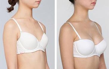 假體豐胸好的醫(yī)院有哪些？假體豐胸介紹？
